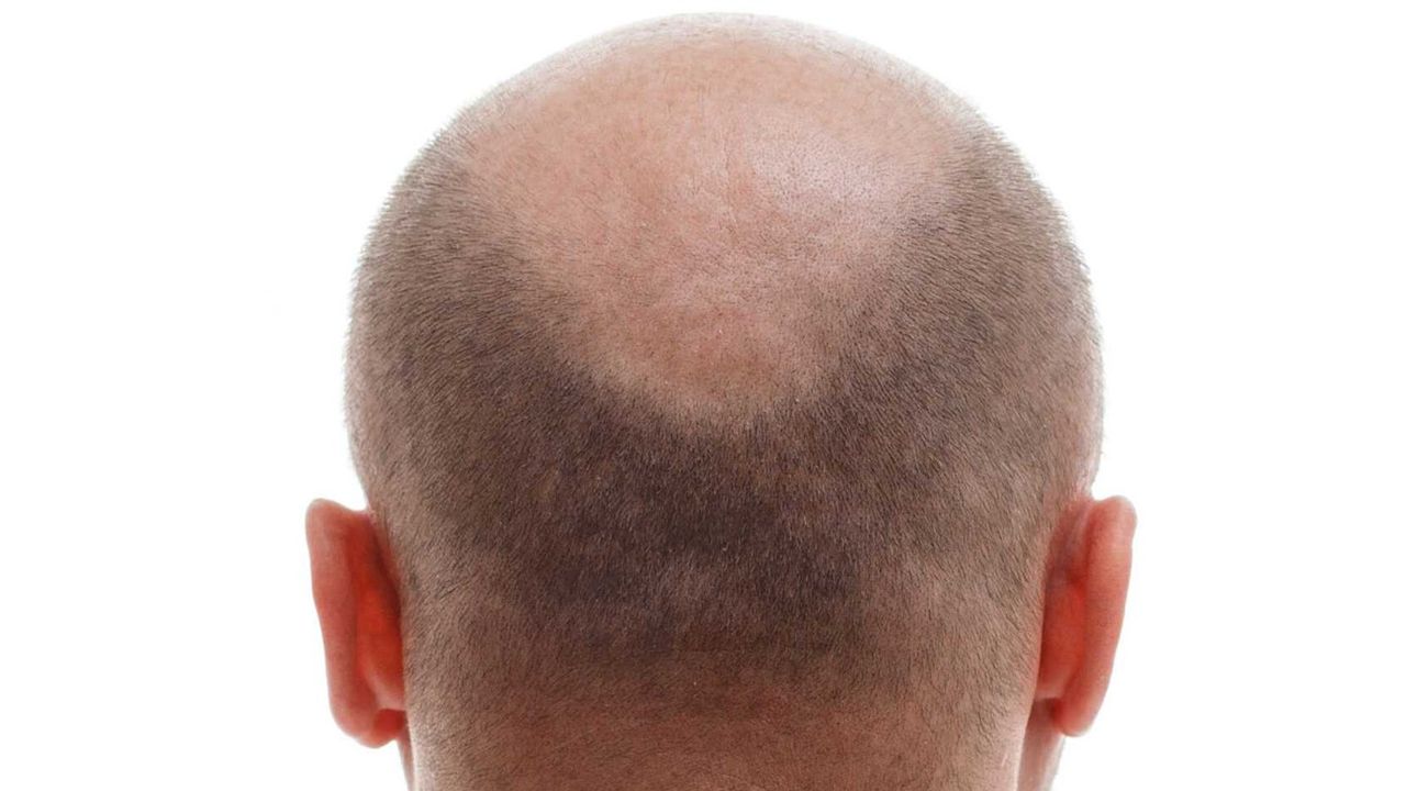 Kel kalmak istemeyenler bu içeçekleri evine bile sokmasın