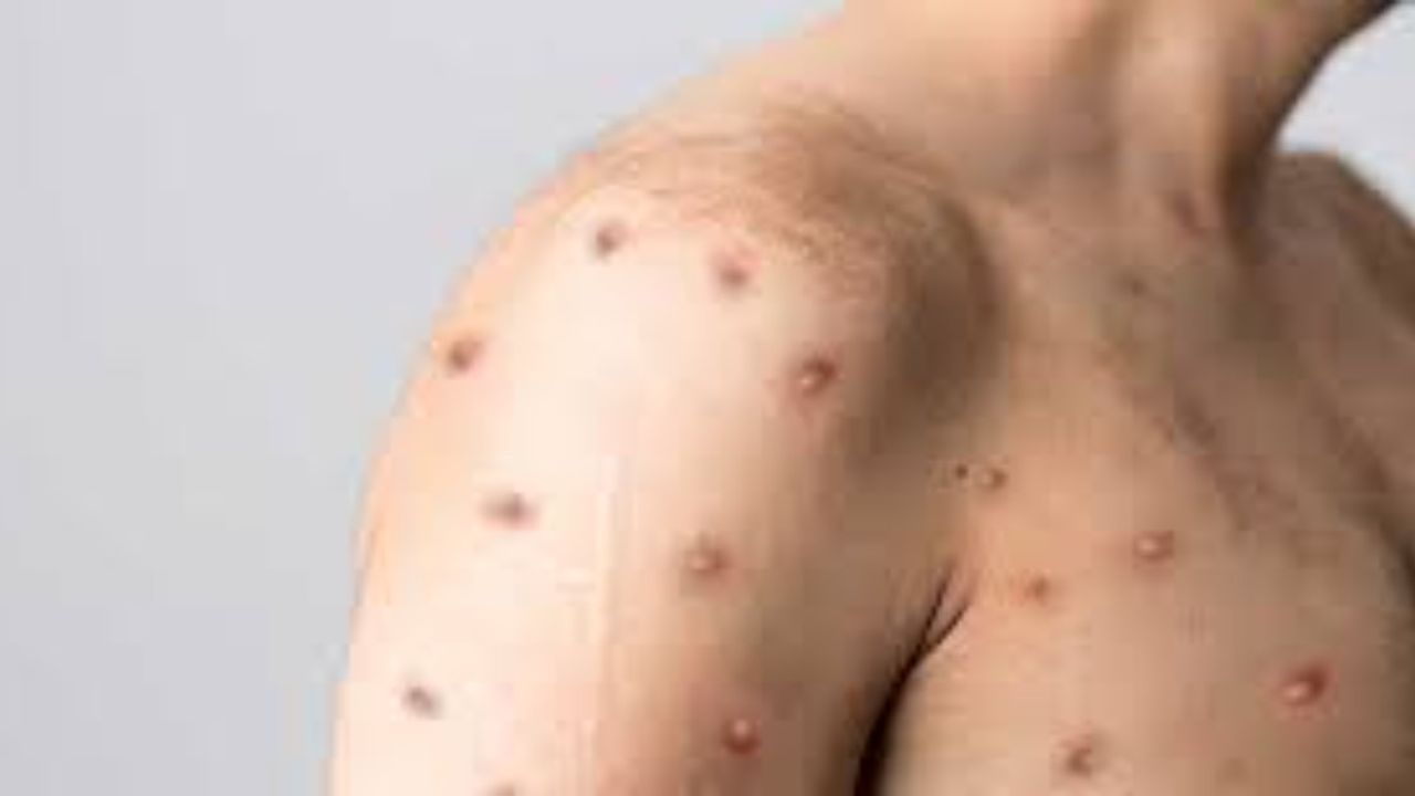 Maymun çiçeği salgınında vaka sayısı 100 bini geçti: Ölü sayısı artıyor