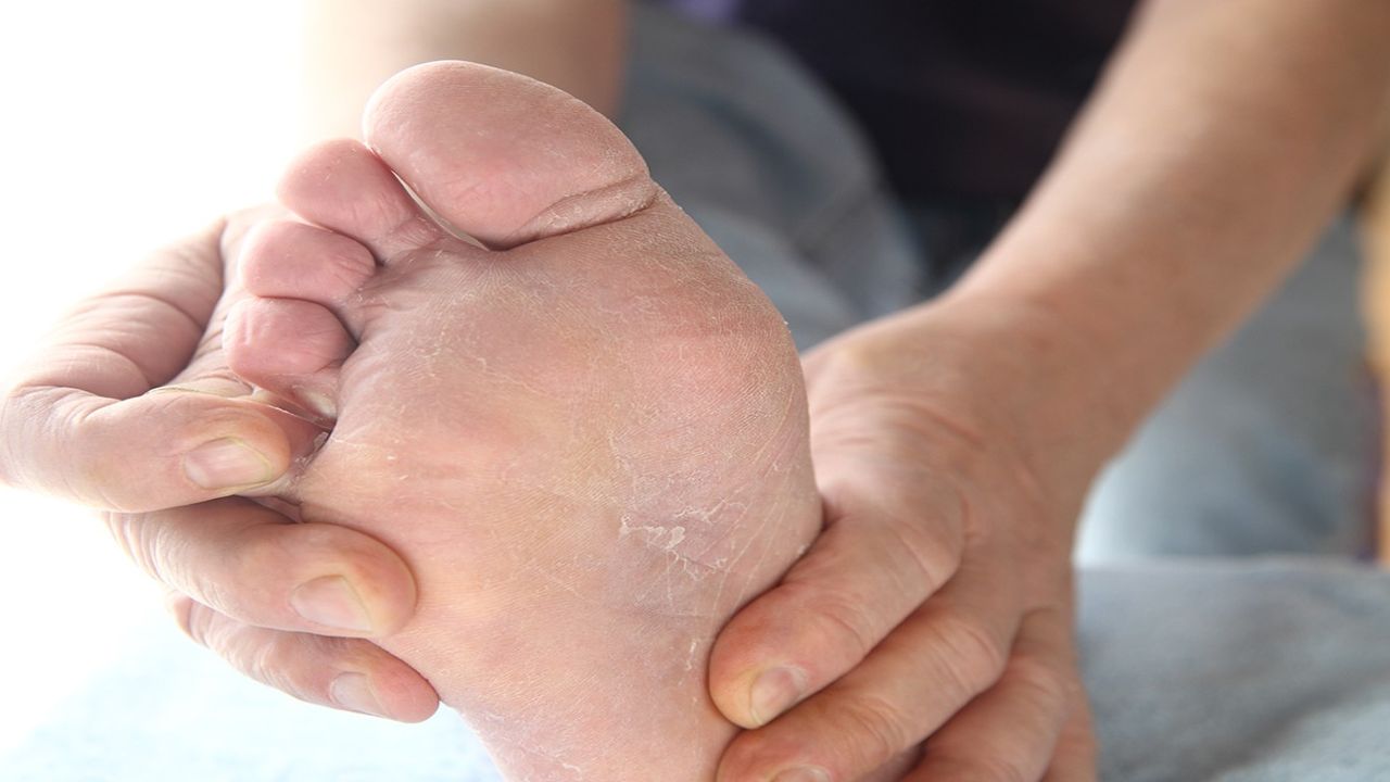 Ayak mantarının doğal çözümü bu kürde saklı!