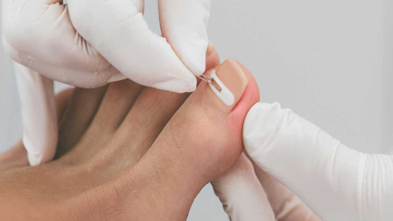 Ayak sağlığını tehdit ediyor! Şifası 1 yemek kaşığı sirkede saklı