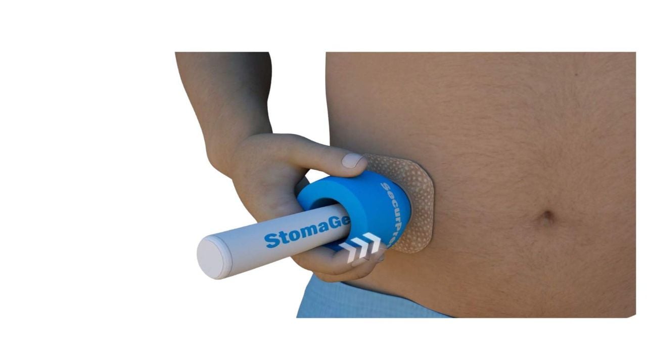 Stoma (Ostomi) hastalığı nedir, belirtileri neler?