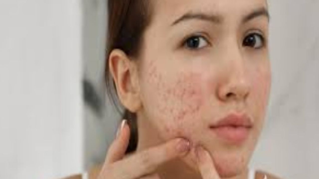 Yüzde çıkan sivilceyi sıkanın VAY haline! Ölüm üçgeni sizi bekliyor