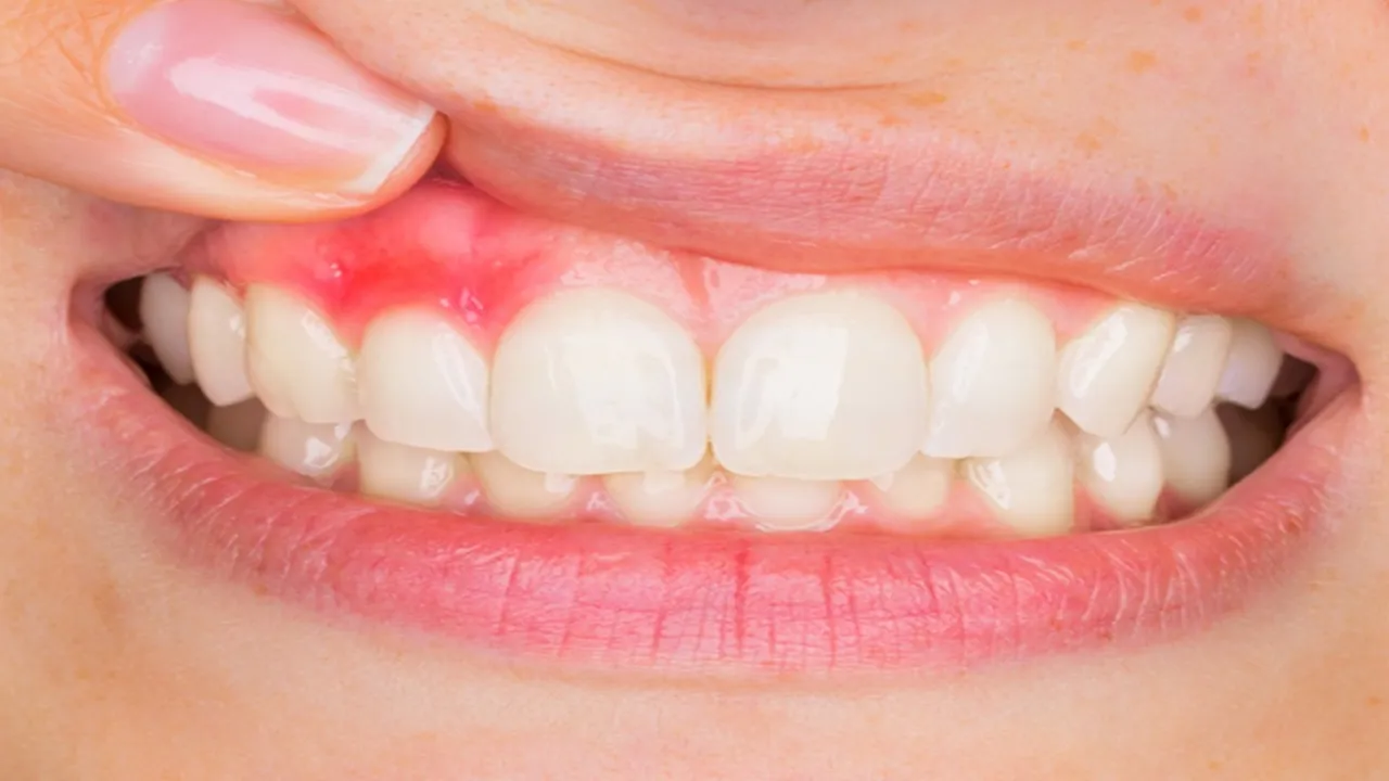 Diş kaybını önlemenin doğal yolu: Diş eti çekilmesine karşı bitkisel çözümler