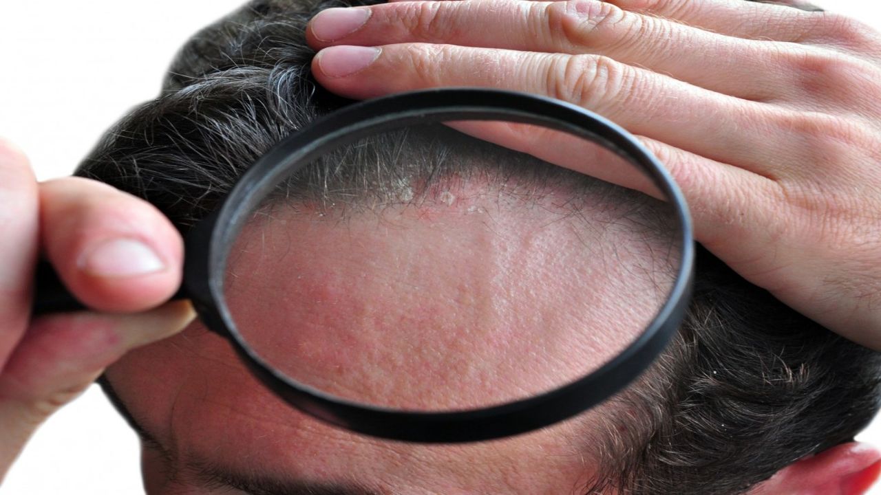 Soğuk hava bile nüksetmesine yetiyor! Peki egzama kış aylarında neden artış gösteriyor?