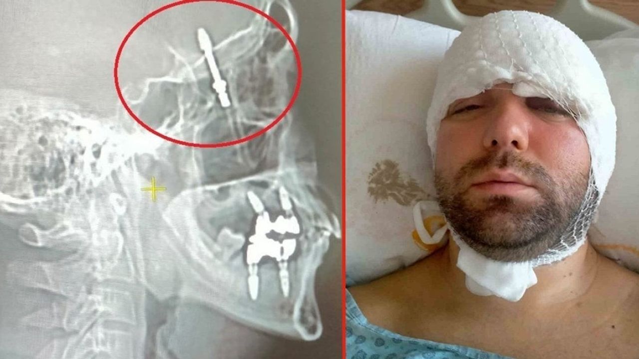 Diş implantı yaptırırken yaşanan korkunç olay: Vida kafatasına saplandı