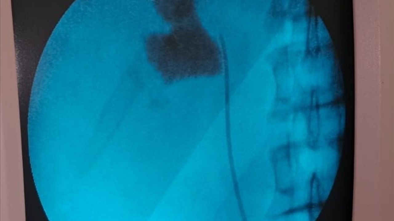 Kırşehir'de Kapalı Ameliyatla 6 Santimetrelik Böbrek Taşı Alındı