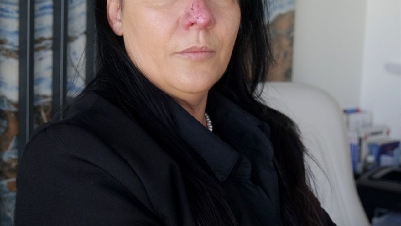 Bursa'da rottweiler saldırısında yüzünde doku kaybı oluşan kadının hukuk mücadelesi sürüyor