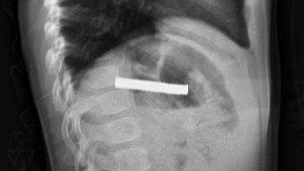 Elazığ'da 3 yaşındaki çocuğun yemek borusundan 19 mıknatıs çıkarıldı