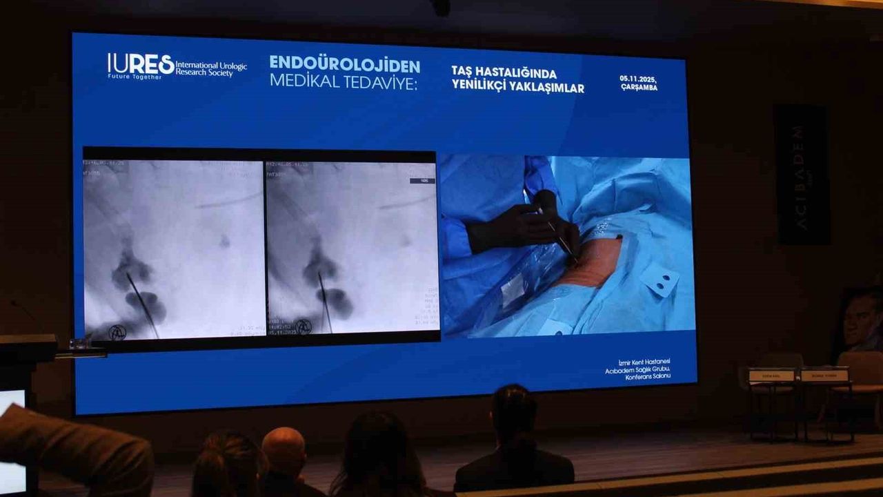 Endoüroloji Hızla Evriliyor: Lazer ve Robotik Sistemler Taş Tedavisinde Öne Çıkıyor