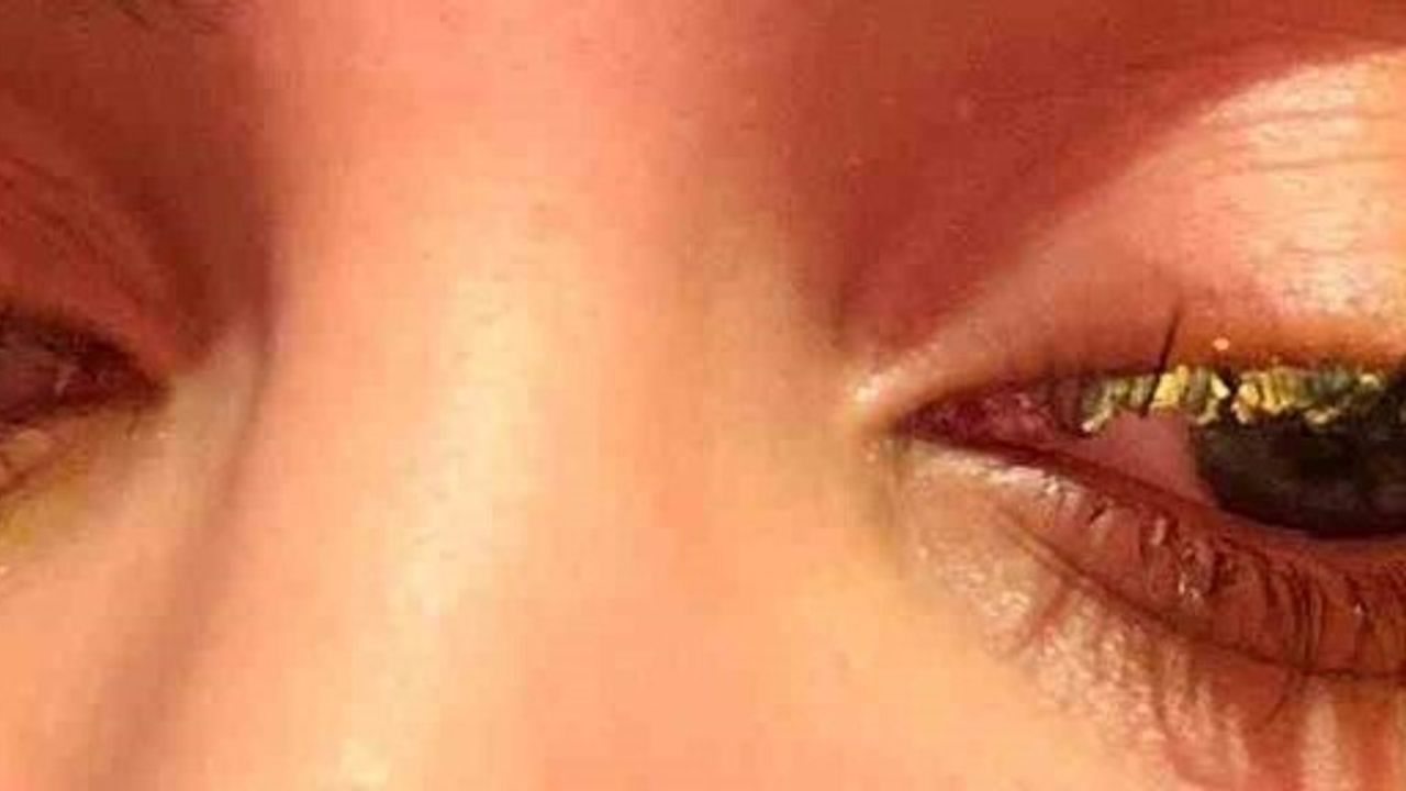 Esenyurt'ta kirpik yapıştırıcısı göze kaçtı: Genç kadın kısmi körlük yaşadı, salon hakkında şikayetçi oldu