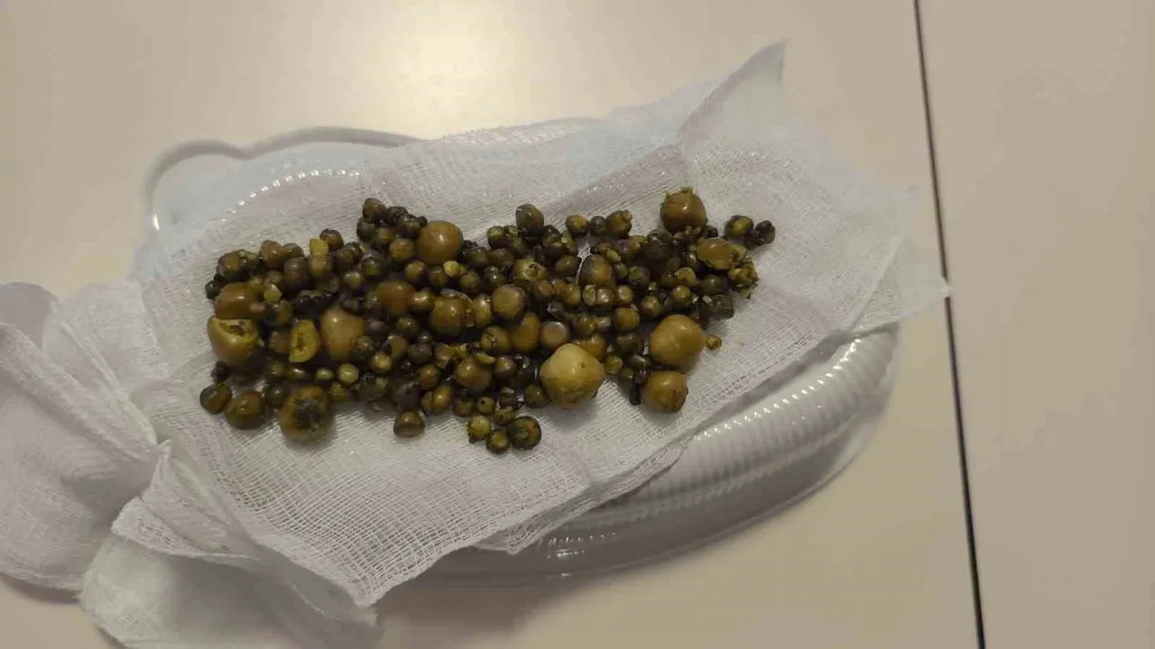 İnegöl'de 77 yaşındaki kadının safra kesesinden 213 taş çıkarıldı