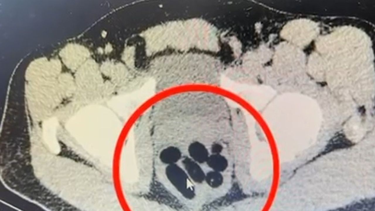 Kayseri’de Narkotik Operasyonunda Kuryenin Midesinde 50 Kapsül Halinde 500 Gram Uyuşturucu Ele Geçirildi