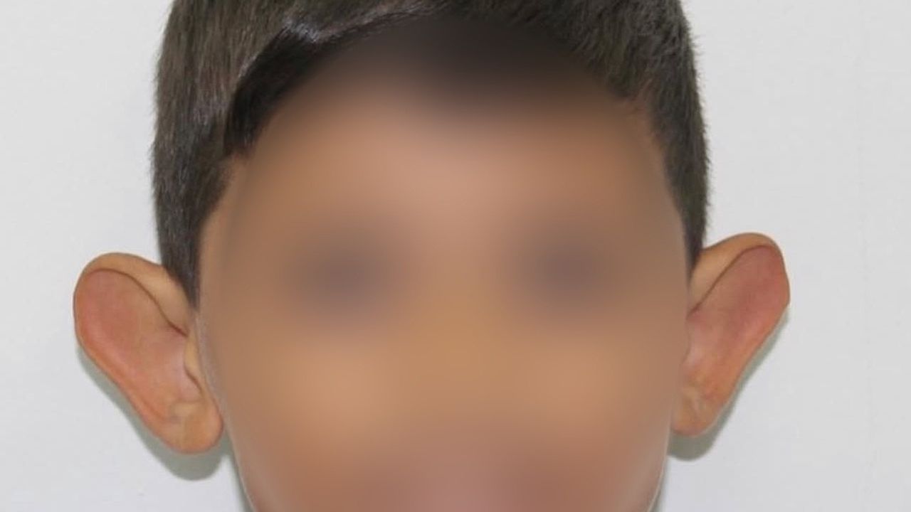 Prof. Dr. Hayati Akbaş: Kepçe kulak tedavisi çocuklarda özgüven için zamanında yapılmalı