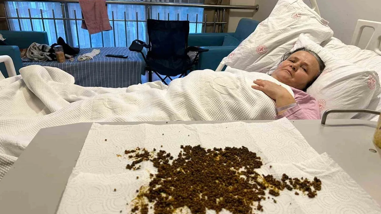 Soma Devlet Hastanesi'nde 70 yaşındaki hastanın safra kesesinden 20 binin üzerinde taş çıkarıldı