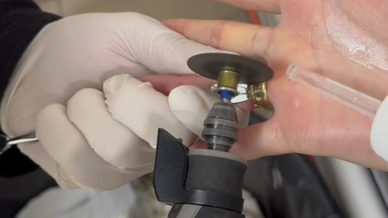 Batman'da parmağına sıkışan iki yüzük itfaiye tarafından spiral makineyle çıkarıldı