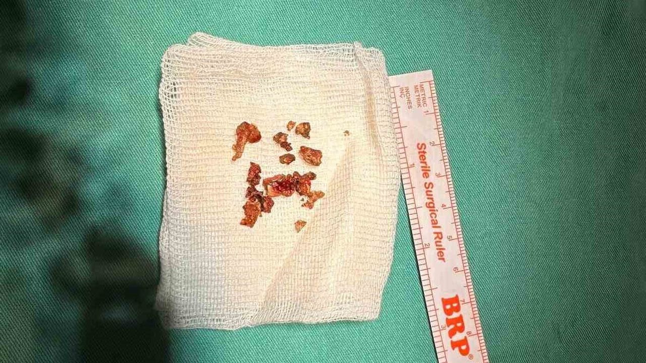 Elazığ'da estetik ameliyat sırasında burunda 'rinolit' (taş) tespit edildi