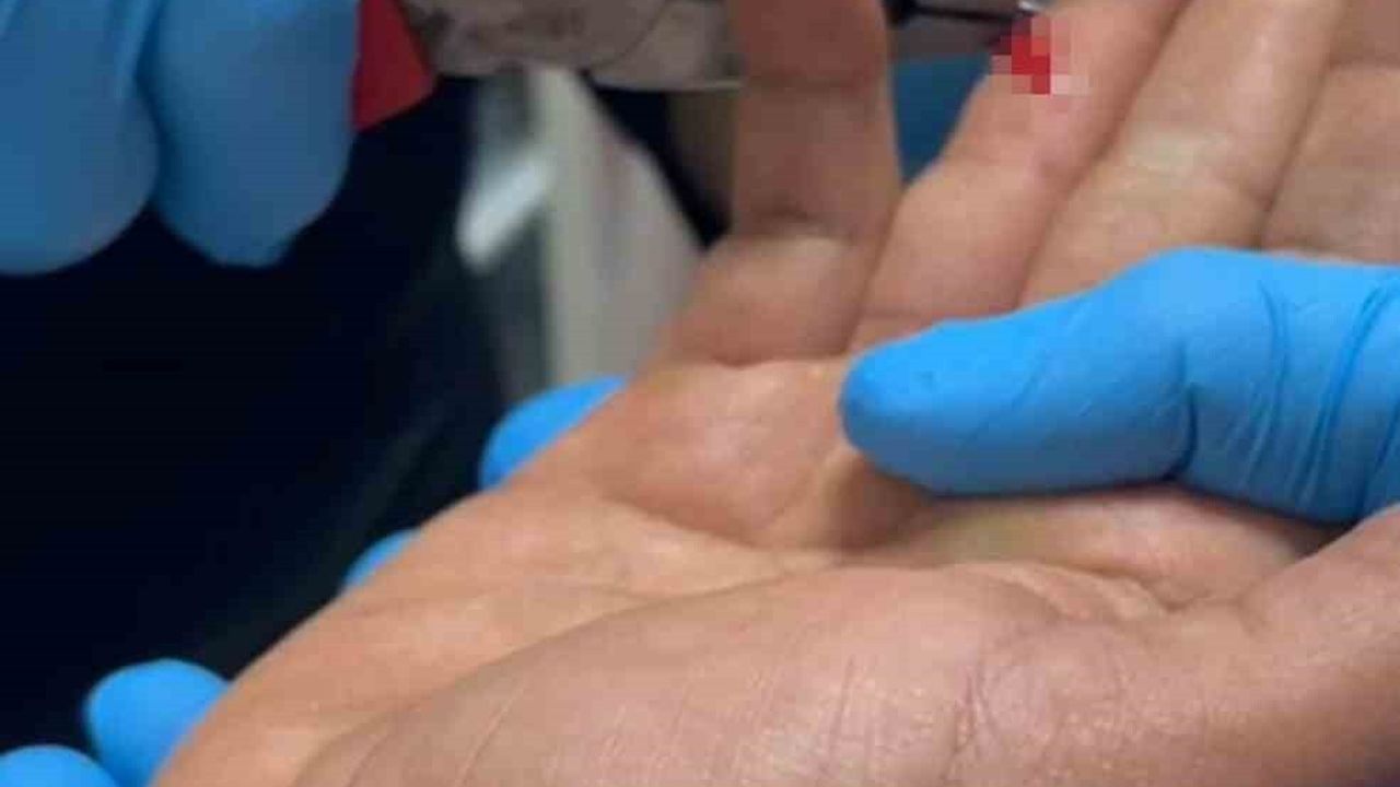 Kahta’da oltanın iğnesi parmağa saplandı; itfaiye doktor gözetiminde çıkardı