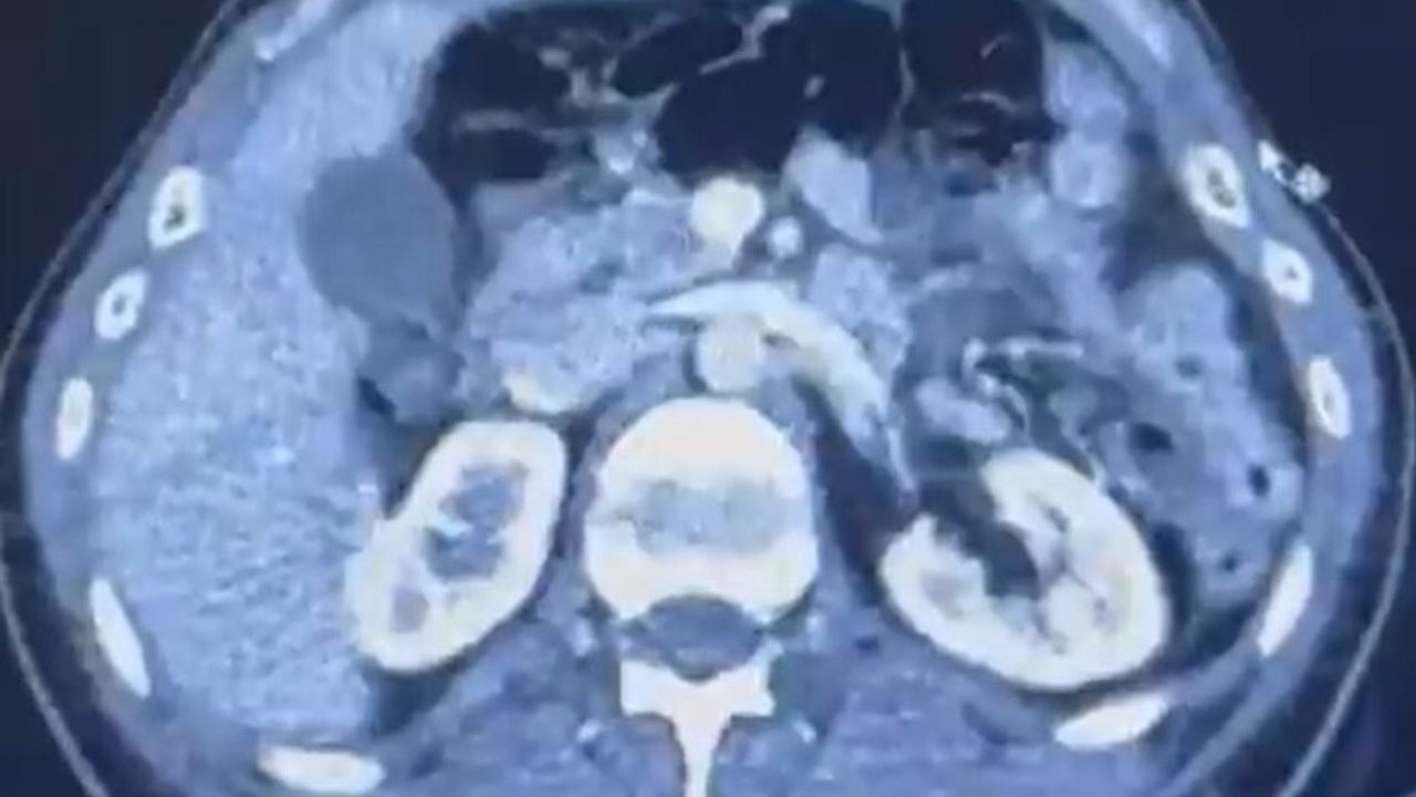 Kayseri'de İran'dan Gelen Şüphelilerin Midesinde 50 Kapsül, 554 Gram Uyuşturucu Ele Geçirildi