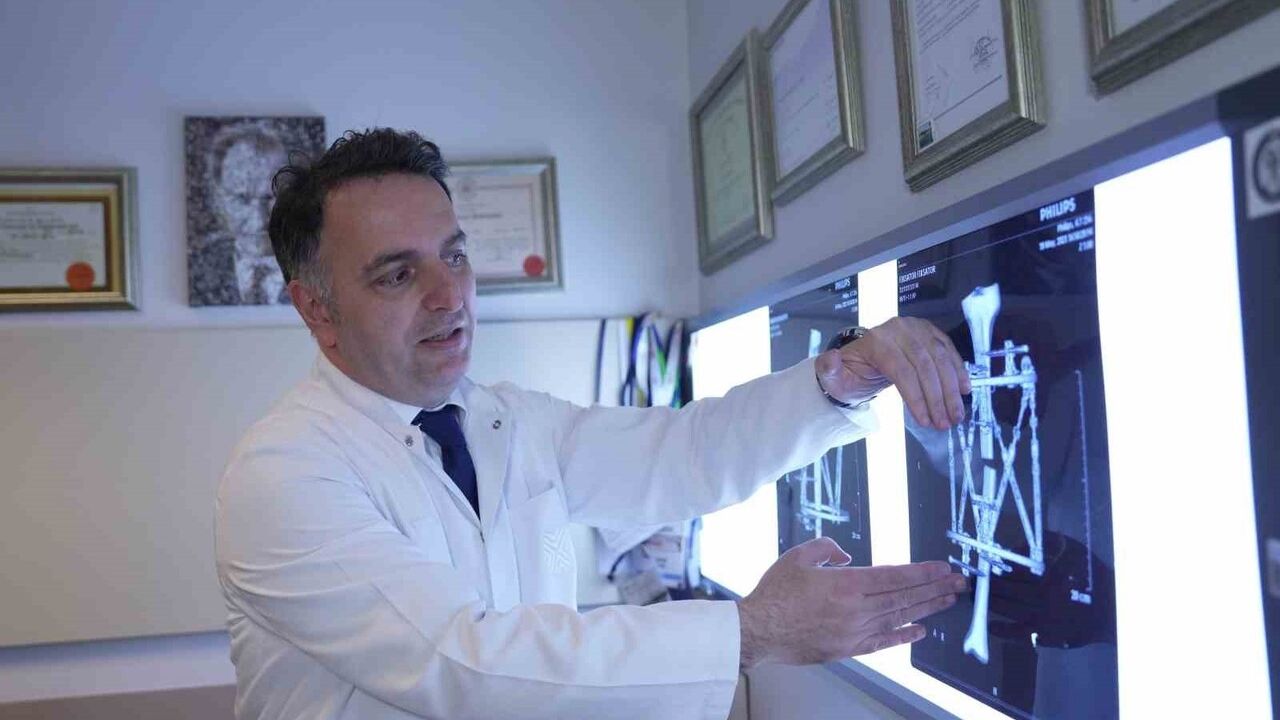 Kemik Uzatma: Distraksiyon Osteogenezisi ve Manyetik Çivilerle Modern Tedavi Yaklaşımları