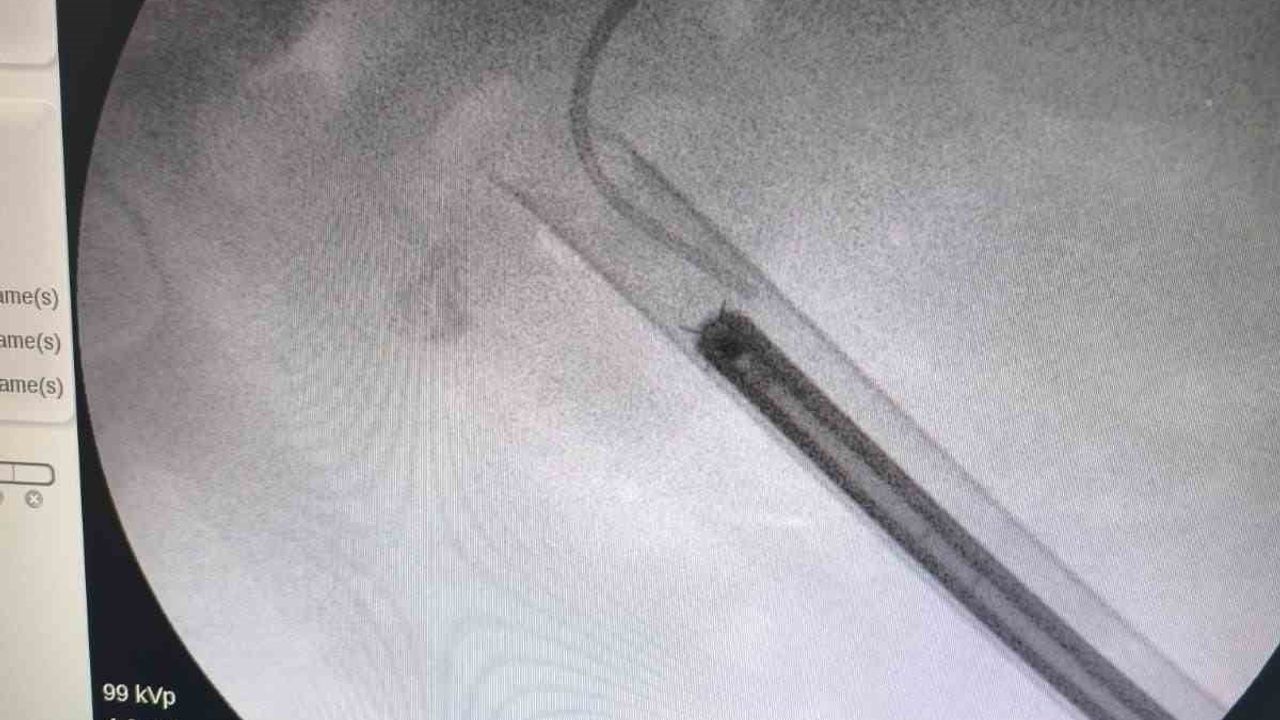 Siirt'te 'geyik boynuzu' böbrek taşı PCNL ile tek seansta temizlendi