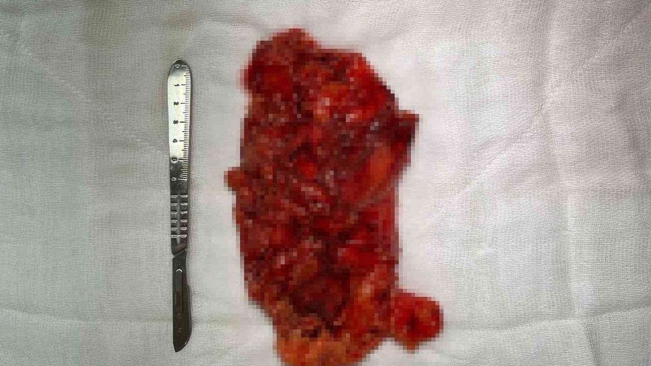 Sivas Devlet Hastanesi, B grubu ikinci basamak olarak ilk laparoskopik nefrektomiyi başarıyla gerçekleştirdi