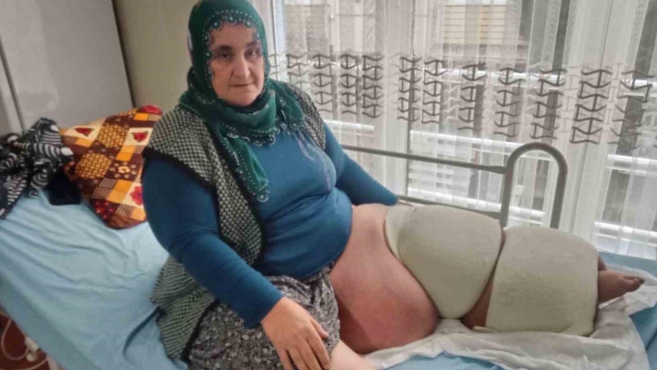 Tarsuslu Cennet Karabacak 35 yıldır süren fil hastalığı tedavisi için destek bekliyor