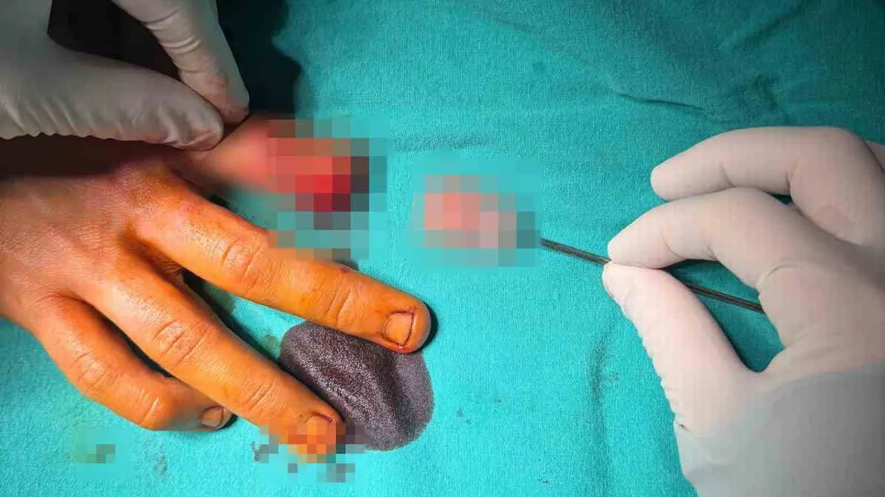 Bandırma'da asansör kazasında kopan parmak mikrocerrahiyle yeniden dikildi