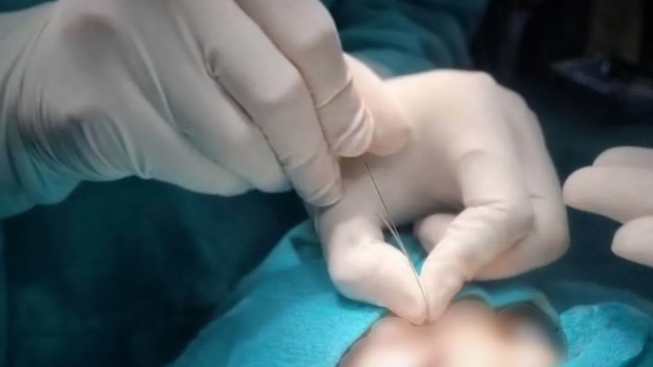 Çukurca Devlet Hastanesi'nde gözyaşı kanalı ameliyatları başladı