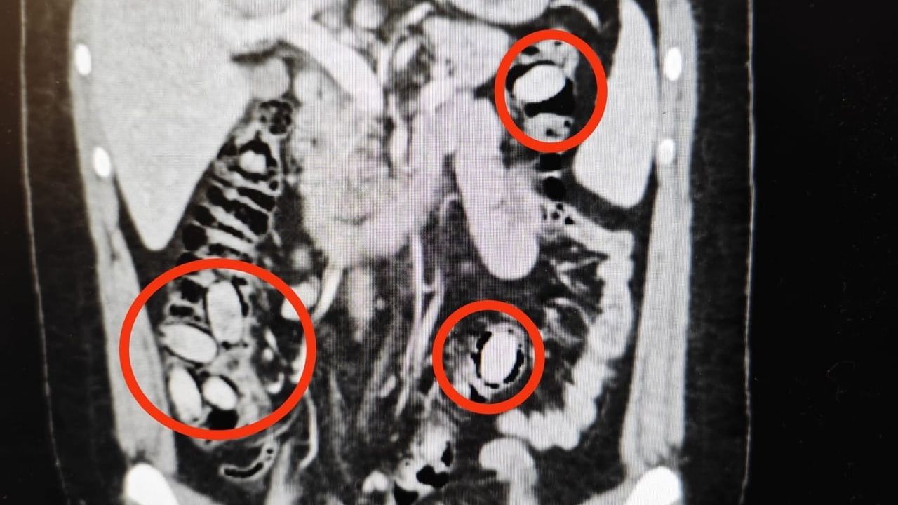 Eskişehir'de midesinde 44 kapsül metamfetamin taşıyan yabancı uyruklu şahıs tutuklandı