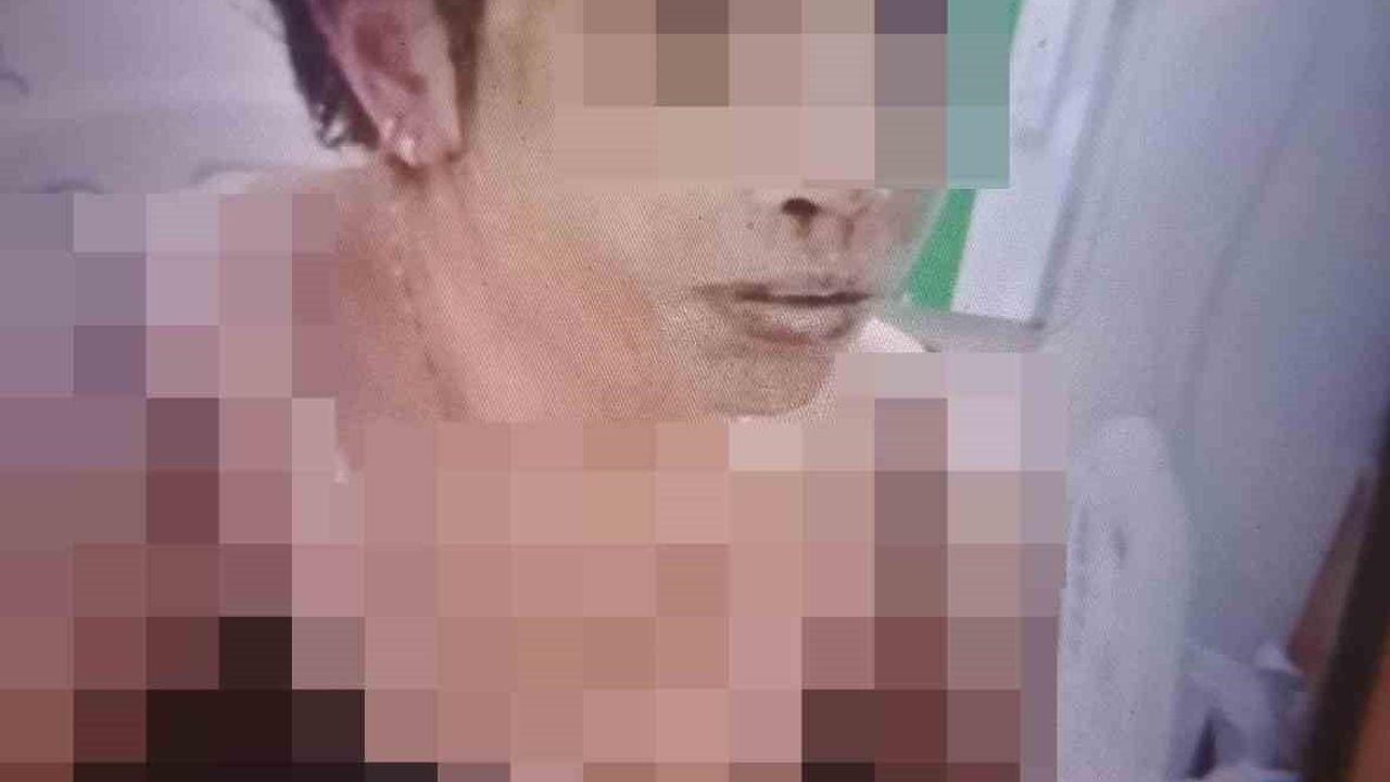 Gaziantep'te eski eşinin kezzaplı saldırısında 31 yaşındaki kadın ağır yaralandı