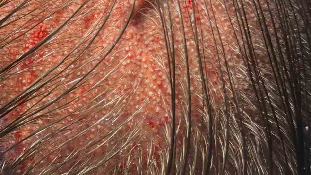 Kadınlarda tıraşsız saç ekimi mümkün: DHI ile doğal görünüm ve kısa iyileşme