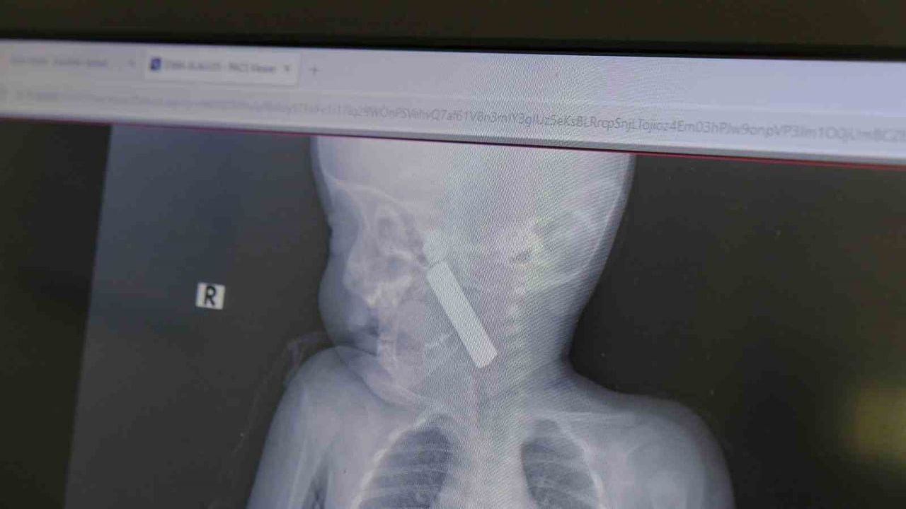 Karaman'da 6 aylık bebeğin boğazından kumanda pili ameliyatla çıkarıldı