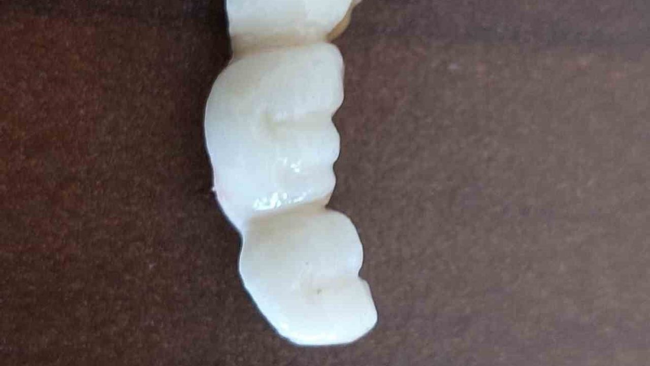 Kayseri'de implantları sürekli düşen hasta: Zemzem Korkmazer yetkililerden yardım istiyor