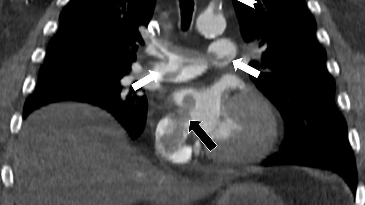 Prof. Dr. Nevzat Karabulut: Kalpteki gizli delikler paradoks emboliye yol açabiliyor