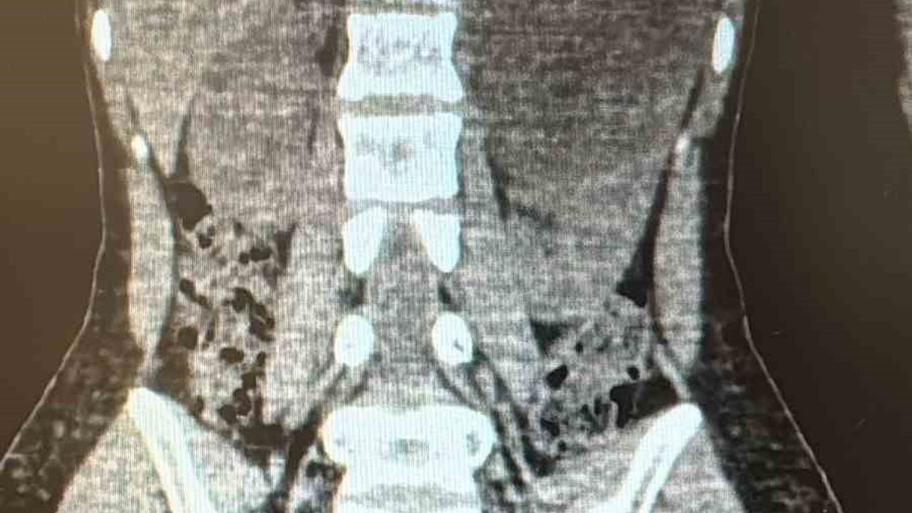 Şanlıurfa'da 10 santimetrelik böbrek kisti laparoskopik yöntemle alındı