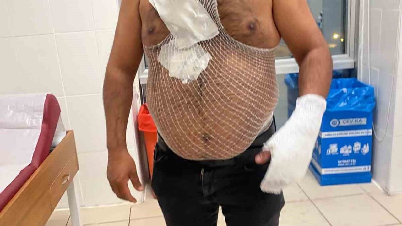 Sivas'ta sosyal medya içerik üreticisi Raşit Yıldırım, sıcak su şovu sırasında yanıklar geçirdi