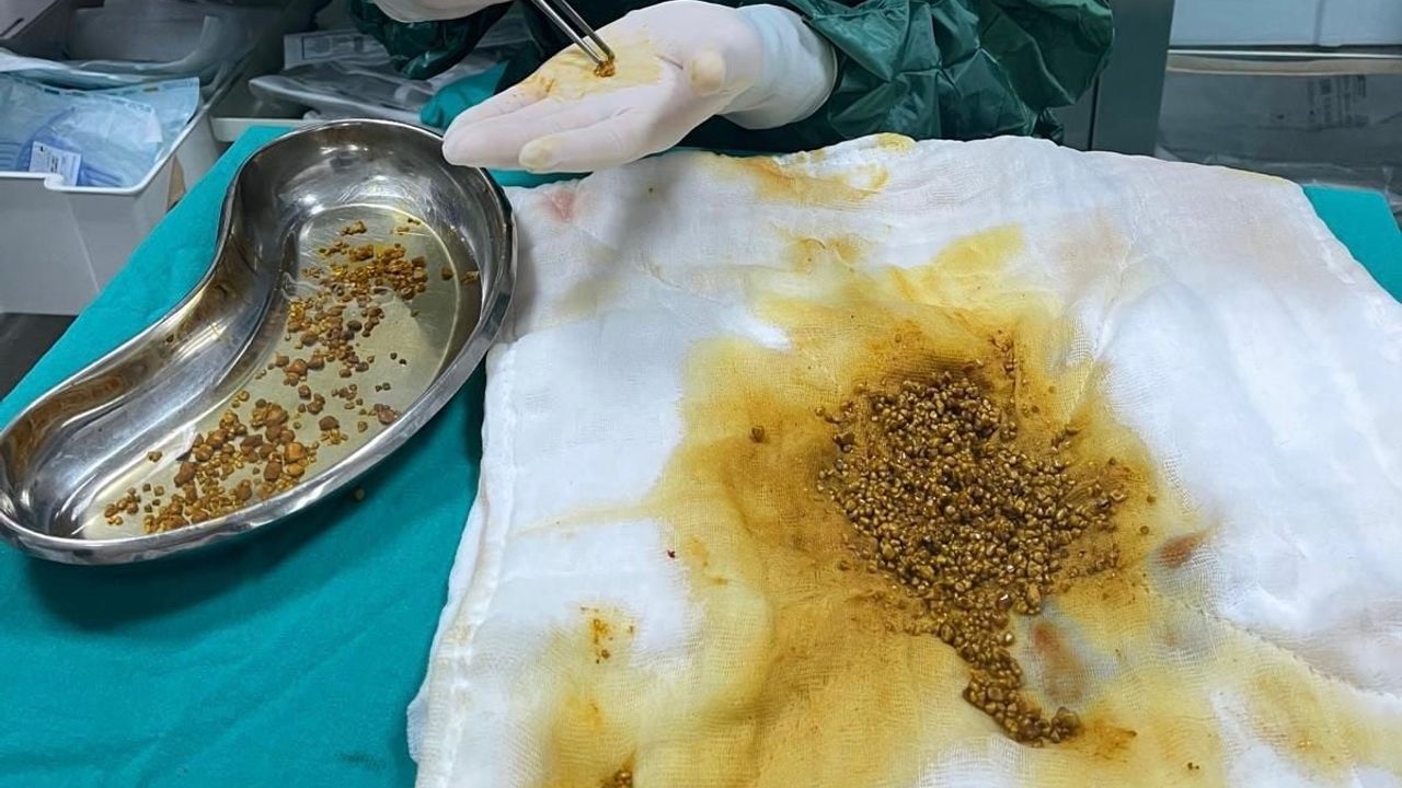 Bingöl Devlet Hastanesi'nde nadir operasyon: Safra kesesinden 2 bin 67 taş çıkarıldı
