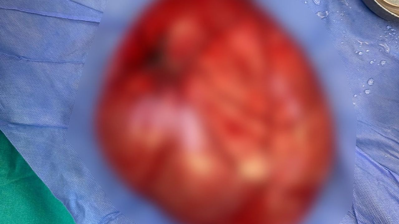 Bolu'da 14 yaşındaki öğrencinin karnından ameliyatla 3,5 kilogramlık kist çıkarıldı