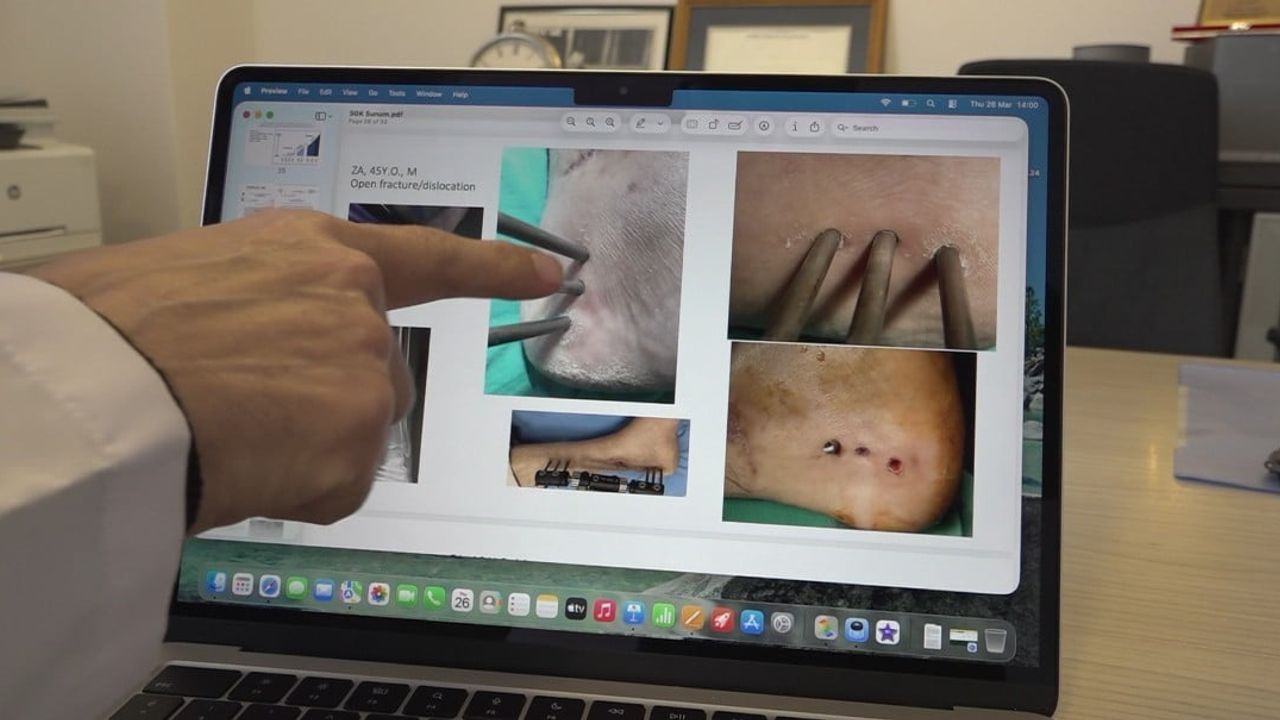 Enfeksiyonlu Bölgeye Uygulanabilen Antibakteriyel Yapay Kemik Grefti Eskişehir’de Geliştirildi