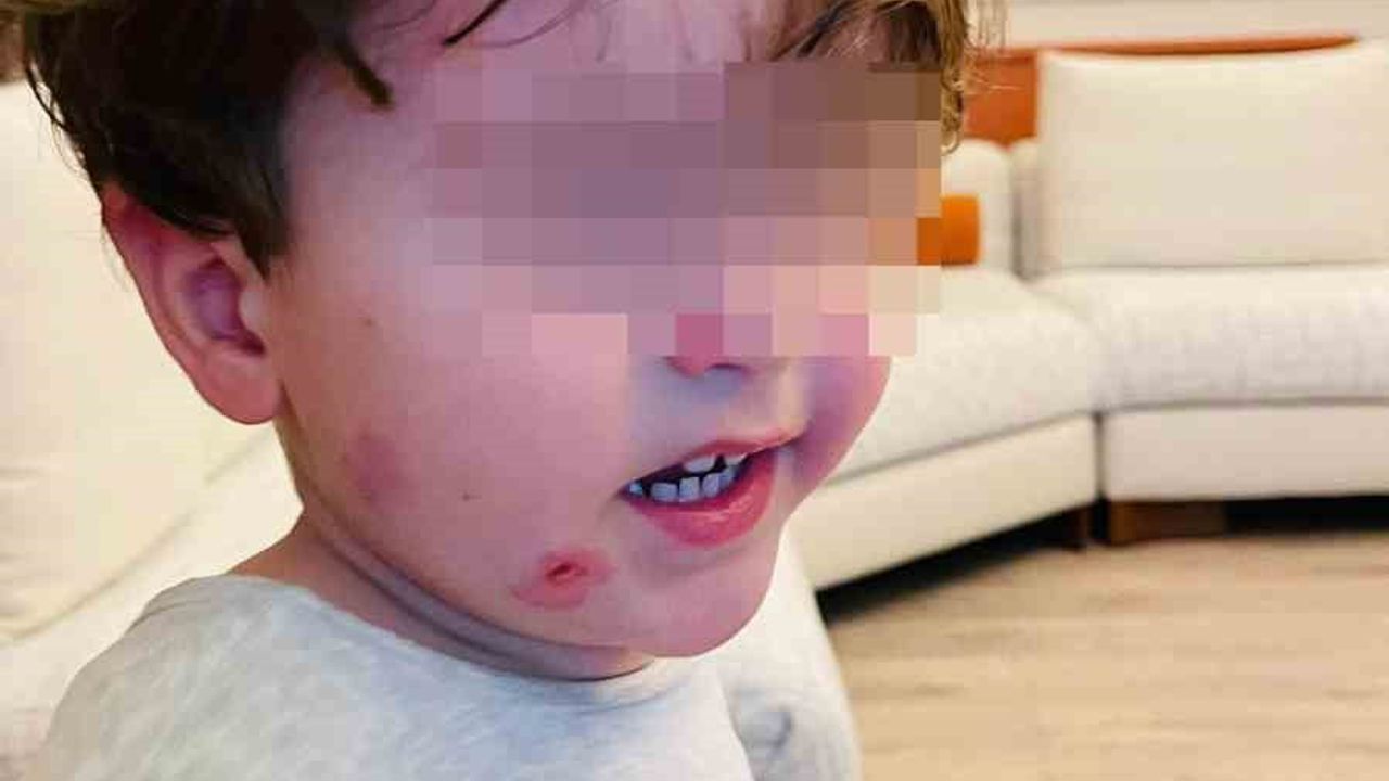 Gemlik'te kreşte darp iddiası: 2,5 yaşındaki çocuk darp izleriyle alındı