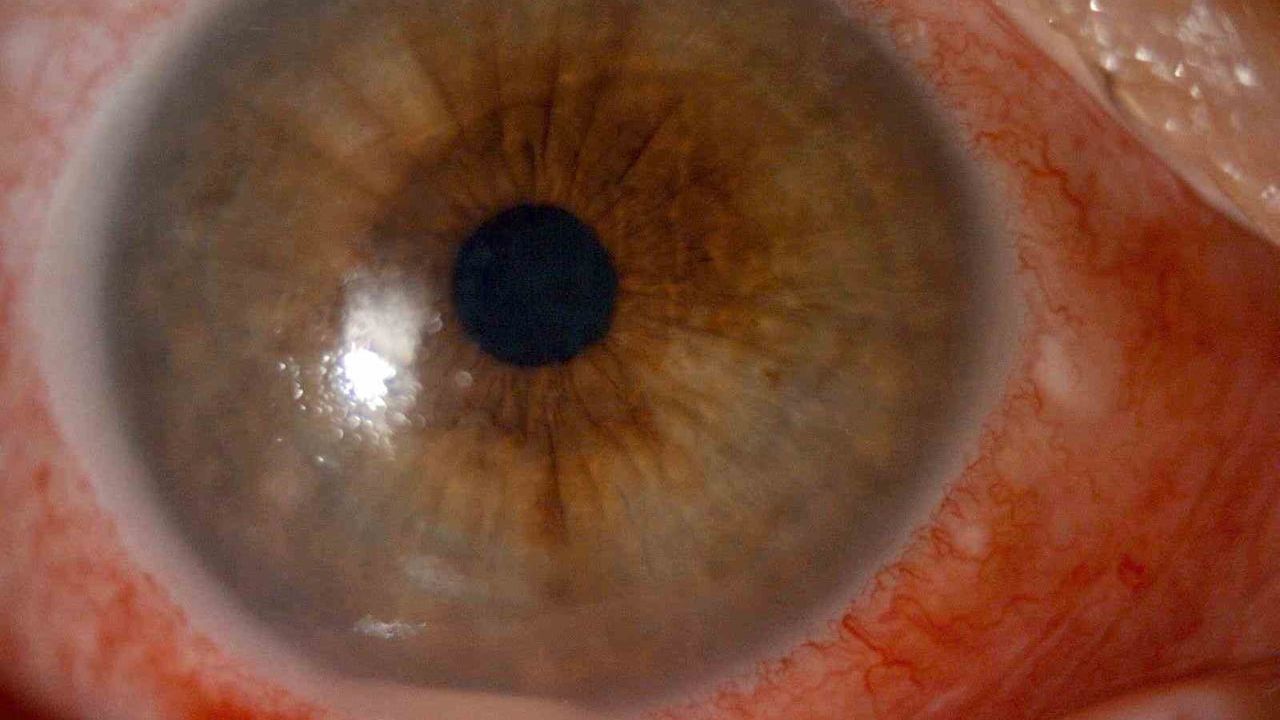 Kırlangıç otu göz uygulamasında kornea hasarı: Kocaeli'de 52 yaşındaki hastada tedaviyle düzelme