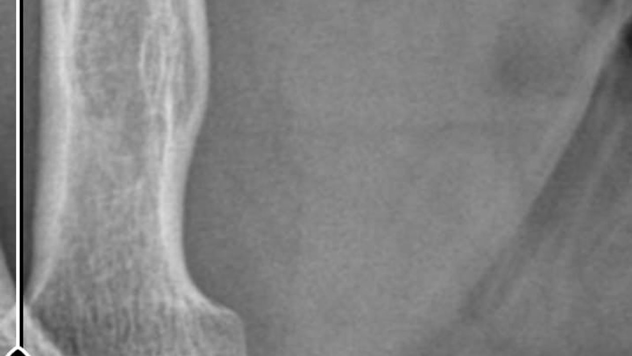 Kocaeli'de Kurban Bayramı'nda Kesilen Parmağı Ampute Edildi; Hasta Savcılığa Suç Duyurusunda Bulundu