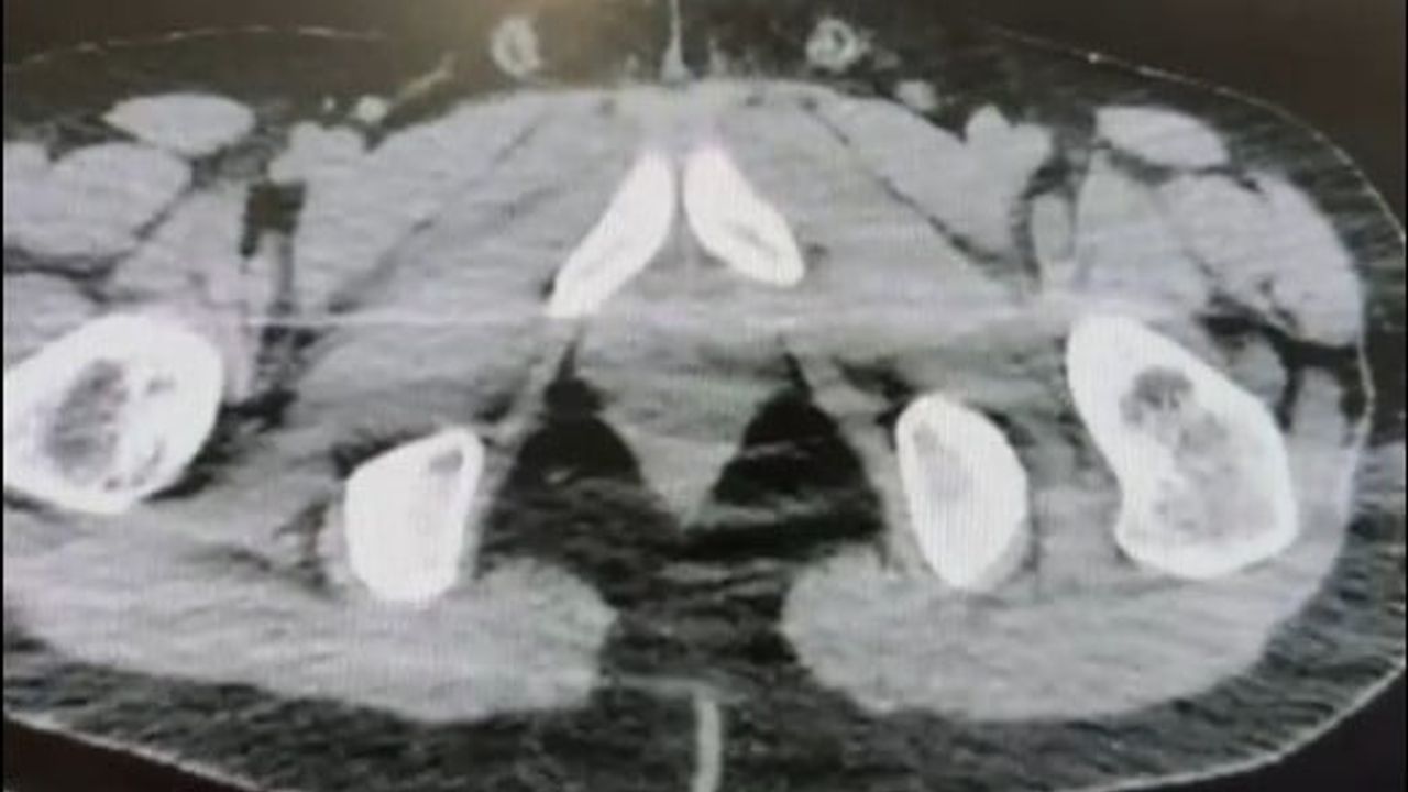 Nevşehir'de midelerinde uyuşturucu sevkiyatı yapan 2 şüpheli tutuklandı