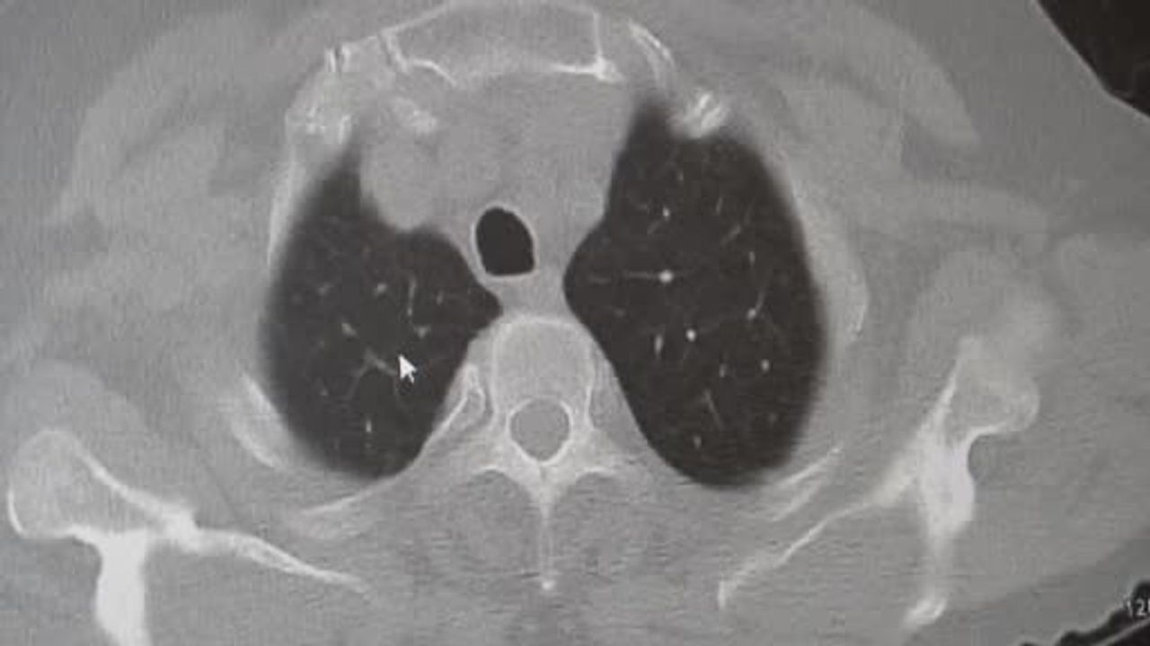 Uzmandan uyarı: KOAH’ın büyük bölümü sigaraya bağlı; zatürreye karşı aşı ve yaşam koşulları önemli