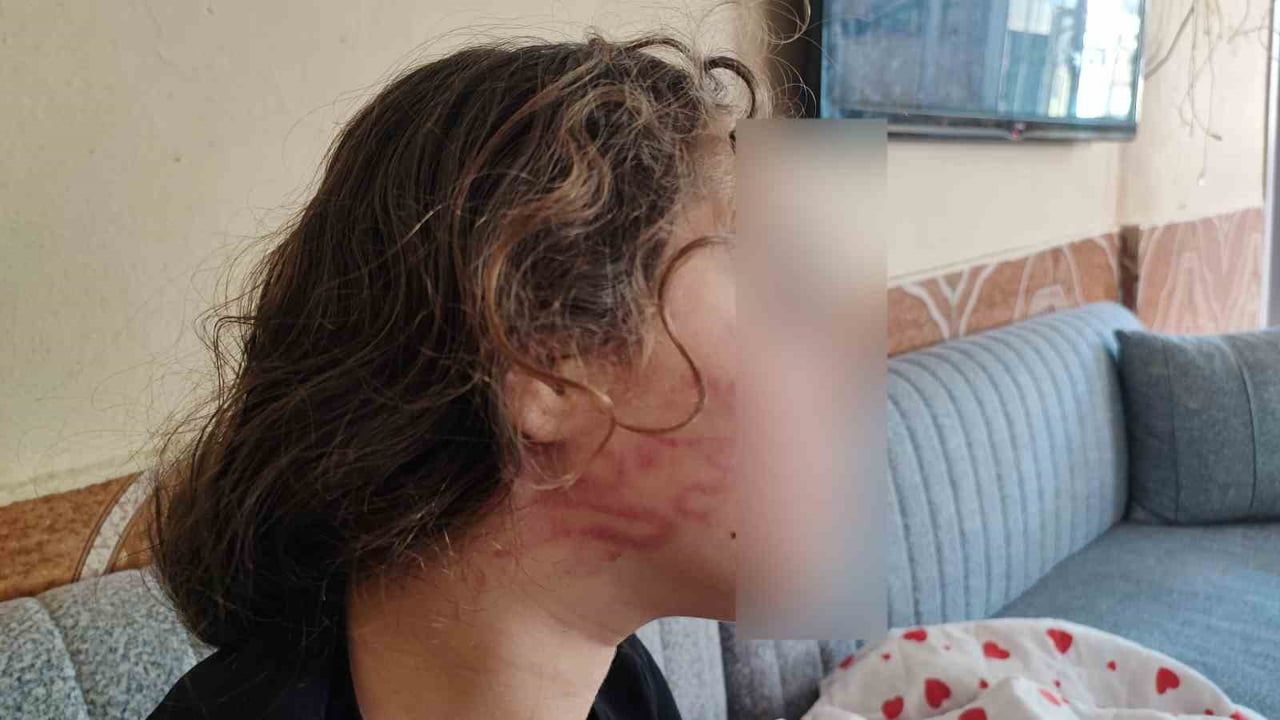 Adana'da kavga sonrası iddia: Kızı darp edildiğini öne süren kadın, epilepsi hastası 11 yaşındaki kıza saldırdı