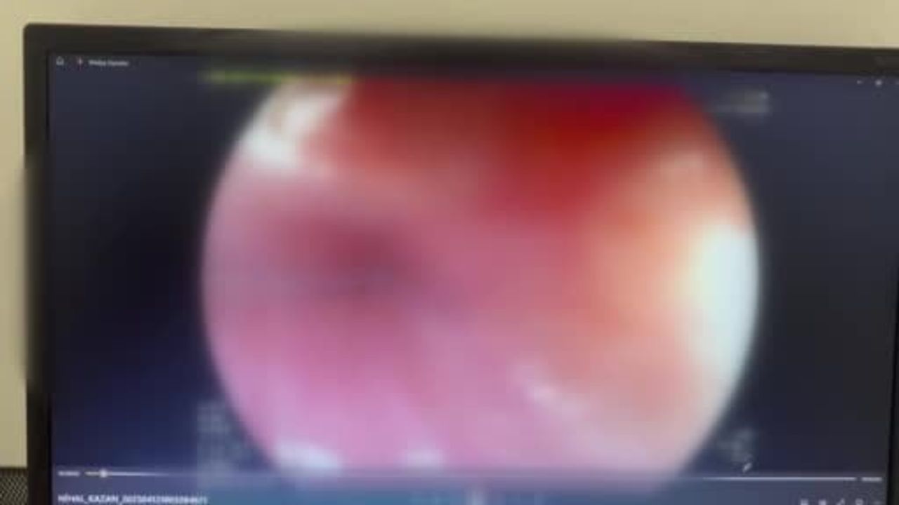 Bursa'da Eti Yerken Boğazına 5 cm'lik Kemik Kaçan 65 Yaşındaki Kadın Endoskopik Müdahaleyle Kurtarıldı