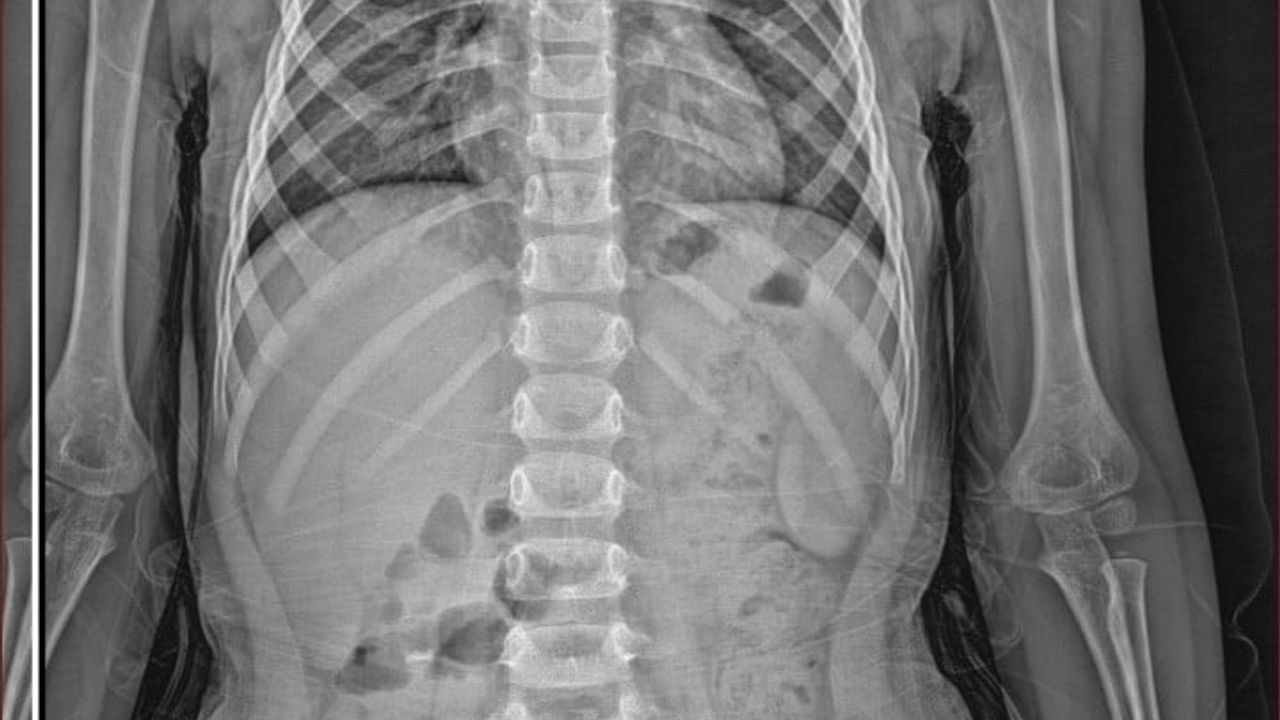 Parkta bulduğu pili şekere benzetip yuttu: 4 yaşındaki çocukta mide yanığı, taburcu edildi