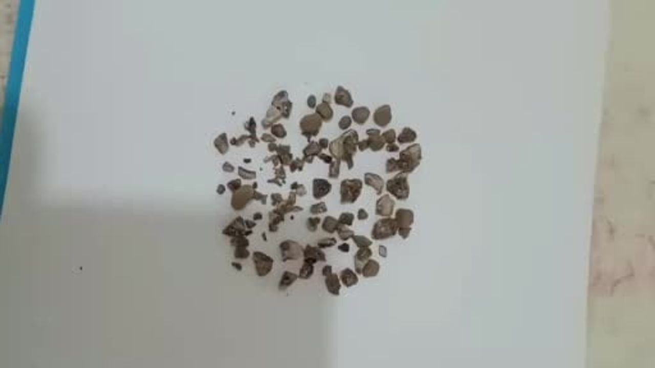Siirt’te kapalı yöntemle staghorn böbrek taşları başarıyla çıkarıldı