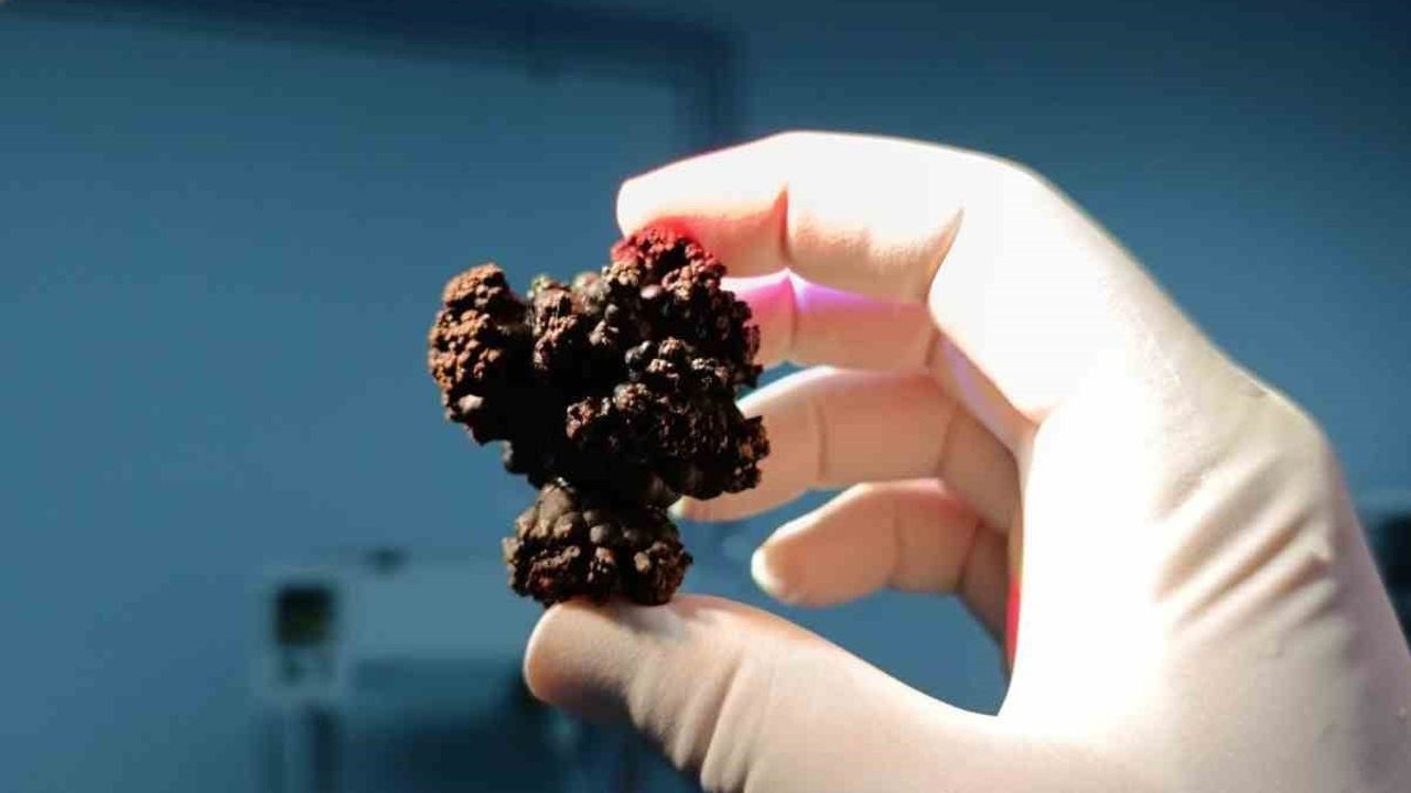 Bozyazı'da 67 yaşındaki hastanın 4 santimetrelik mesane taşı tek parça halinde çıkarıldı