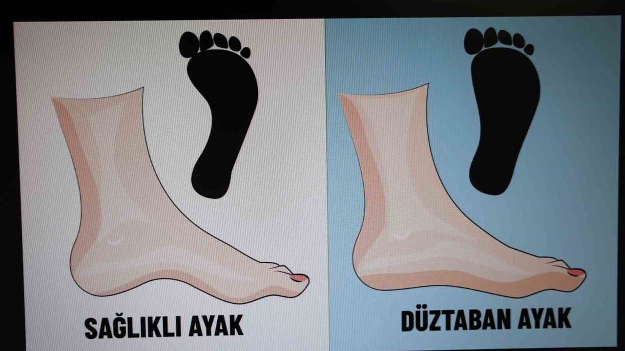 Dr. Ömer Ayhan: Çocuklarda düztabanlığın yüzde 90'ı geçici; tedavi yaşa göre planlanıyor